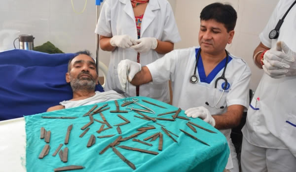 In 2016, surgeons removed 40 metal knives from a patient who spent two months swallowing them, according to the doctor who led the operation. The unnamed 42-year-old man, who had an "uncontrollable urge" to eat the knives, went to a hospital in Gurdaspur in Northern India after complaining of stomach pain and weakness. Only after an ultrasound revealed a large mass in his stomach, did the man tell doctors he had swallowed knives.

Malhotra said they found folded knives, unfolded knives, and rusted and broken knives in the man's stomach. "I'm sorry I let my family down," the father of two said. “I'll be forever thankful to doctors and hospital staff for saving my life.”