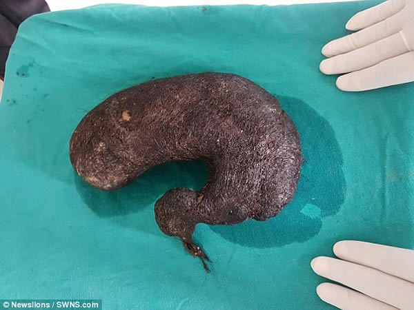 A teenage girl is finally able to eat properly after doctors removed a hairball the size of a melon from her stomach. Aakansha Kumari had secretly been eating her hair for years, but her parents noticed something was wrong when her weight plummeted to just over two stone. So, doctors carried our an X-ray which revealed a huge mass that was taking up more than 80% of her stomach. 

Kumari was diagnosed with Rapunzel syndrome, a rare condition in which a hairball (called a trichobezoar) is found in the stomach, with its tail in the colon. Named after the Grimms fairy tale character, it is associated with trichotillomania, where sufferers have an irresistible urge to pull out one's hair, and trichophagia, the compulsive eating of hair.