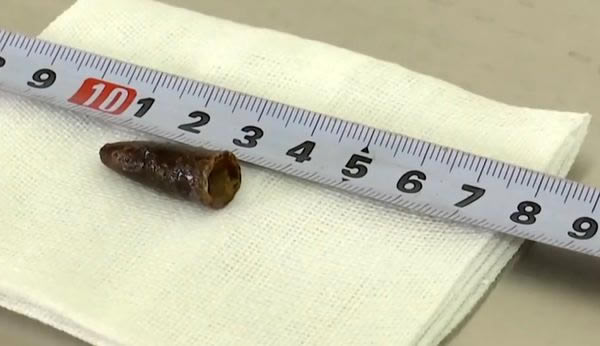A man lived almost 20 years with a plastic pen cap lodged in one of his lungs after he inhaled it as a child and forgot about it. Doctors found and removed the partially-dissolved cap after the man started coughing up blood and went to the hospital. When they showed it to him, he recalled accidentally inhaling the pointed object when he was a youngster in the 1990s.

He suffered fits of coughing throughout his childhood and early 20s but never thought that it was due to the pen cap. His symptoms have since been relieved following surgery.