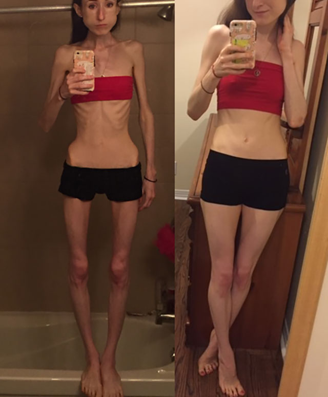 One year of anorexia recovery. 60lbs to 95lbs