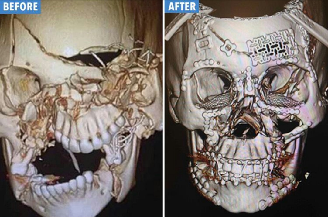 Before and After pics of a woman who underwent 8hrs of facial reconstructive surgery after a traumatic car crash