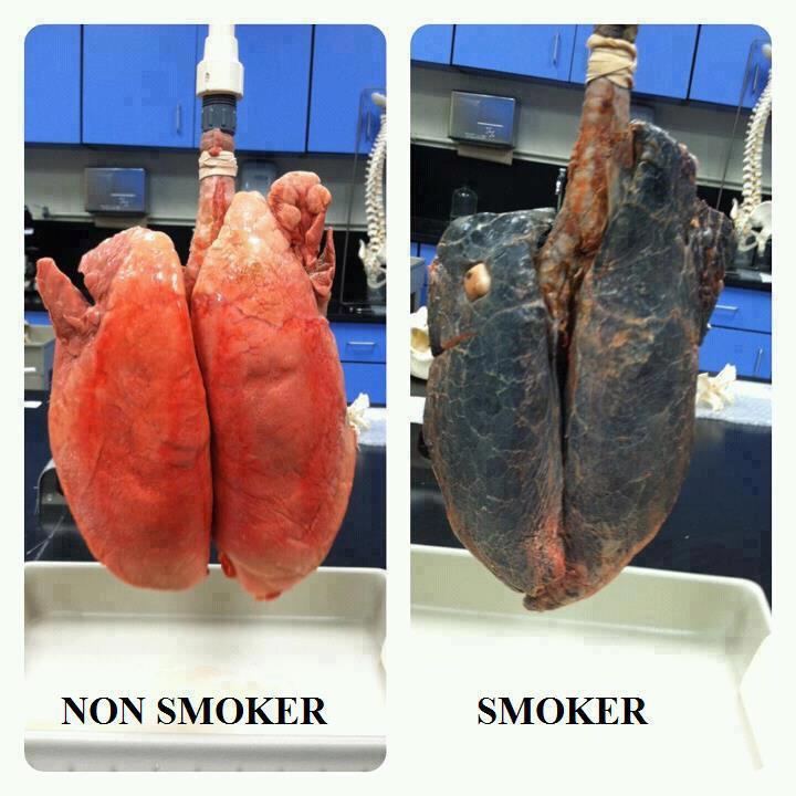Smoker vs Non-smoker lungs