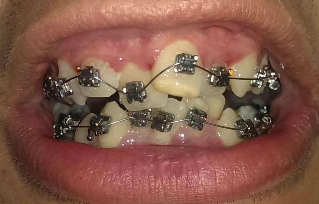 Braces before and after (3 years)