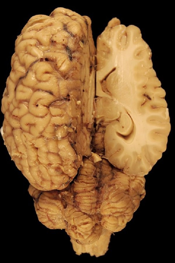 The human brain isn’t as dense as you might imagine. In fact, it’s quite fragile, like jell-o or tofu.