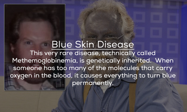 photo caption - Blue Skin Disease This very rare disease, technically called Methemoglobinemia, is genetically inherited. When someone has too many of the molecules that carry oxygen in the blood, it causes everything to turn blue permanently.
