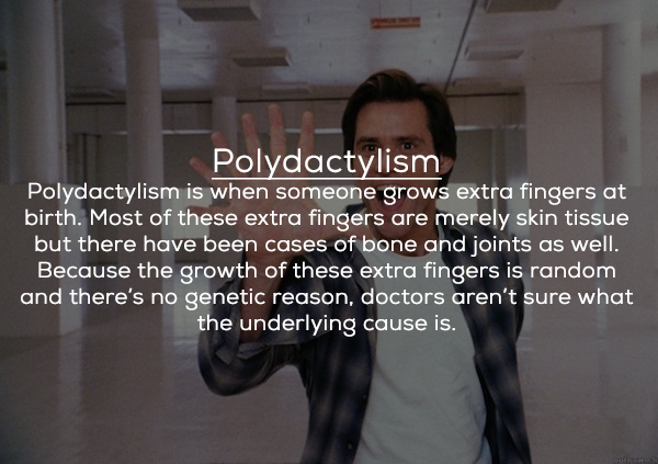 photo caption - Polydactylism Polydactylism is when someone grows extra fingers at birth. Most of these extra fingers are merely skin tissue but there have been cases of bone and joints as well. Because the growth of these extra fingers is random and ther