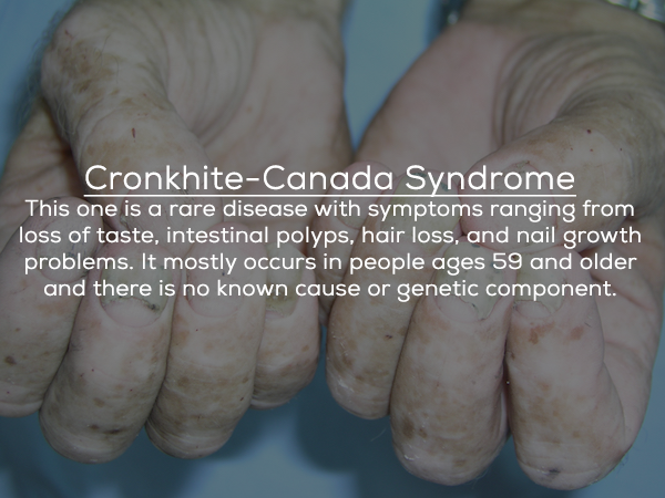hand - CronkhiteCanada Syndrome This one is a rare disease with symptoms ranging from loss of taste, intestinal polyps, hair loss, and nail growth problems. It mostly occurs in people ages 59 and older and there is no known cause or genetic component.