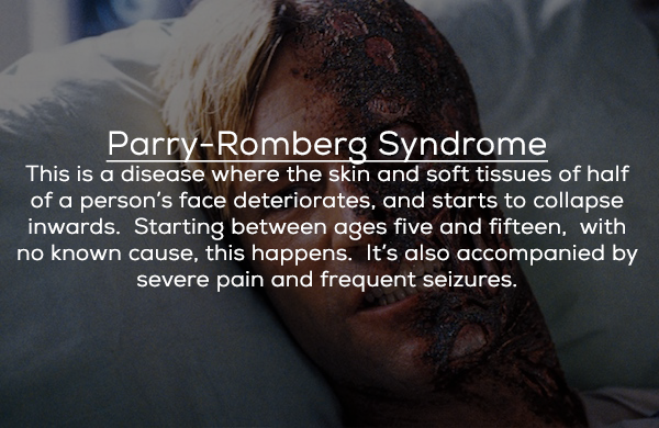 photo caption - ParryRomberg Syndrome This is a disease where the skin and soft tissues of half of a person's face deteriorates, and starts to collapse inwards. Starting between ages five and fifteen, with no known cause, this happens. It's also accompani