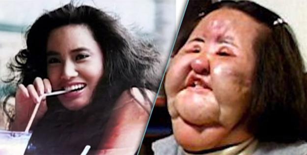 This is what happens when you inject cooking oil instead of silicone in your face