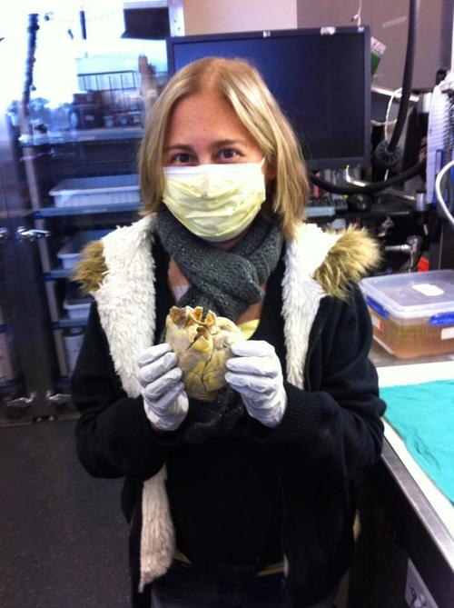 Penny, a transplant recipient, holding her Heart in her hands