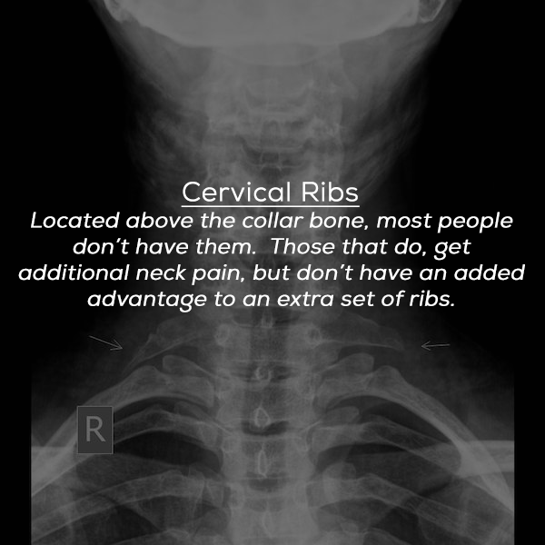medical radiography - Cervical Ribs Located above the collar bone, most people don't have them. Those that do, get additional neck pain, but don't have an added advantage to an extra set of ribs.