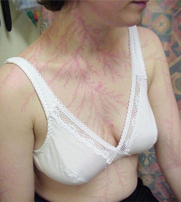 Lichtenberg figures – scars from being struck by lightning