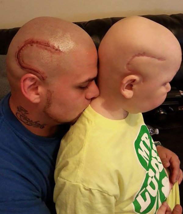 “Dad Tattoos His Son’s Cancer Scar On His Own Head To Boost Son’s Self-Confidence.”