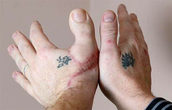 A hand with a big toe transplanted in place of a lost thumb.