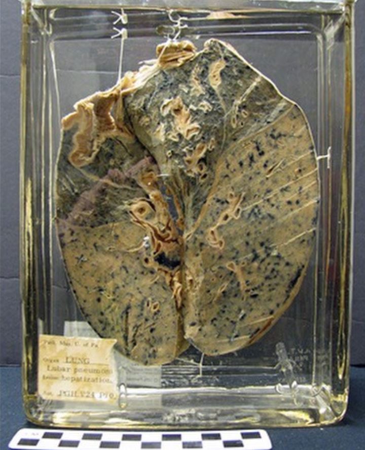 This is what the human lungs infected with pneumonia look like.