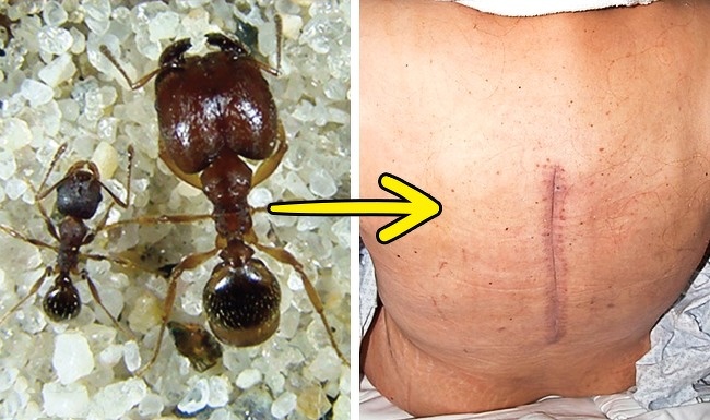 Soldier ants were used to stitch wounds. Indians are known in history as very independent and strong people. They were so strong and stern that they sewed up wounds with the help of soldier ants. These insects with their jaws grabbed the edges of the wound and did not allow them to separate.