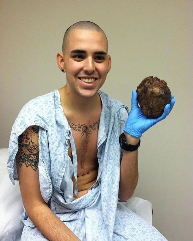 A man holds his old diseased heart after a heart transplant.