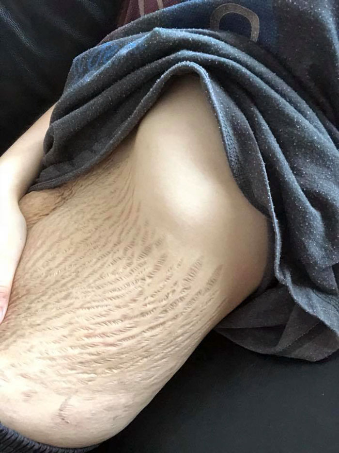 She shared a private photo of her deep stretch marks, and 23K people have already reacted to it while 12K shared it