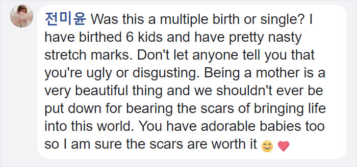 point - 101 Was this a multiple birth or single? || have birthed 6 kids and have pretty nasty stretch marks. Don't let anyone tell you that you're ugly or disgusting. Being a mother is a very beautiful thing and we shouldn't ever be put down for bearing t