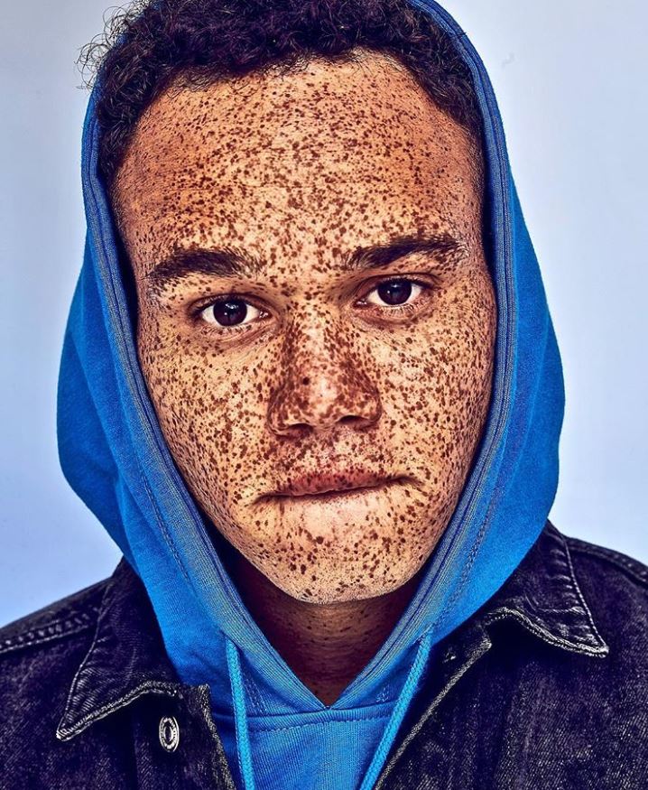 Hamad Jaman covered with freckles