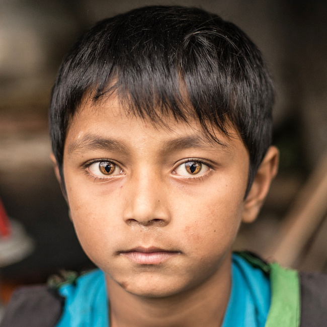 “A kid from Nepal with Cat eye syndrome.”
