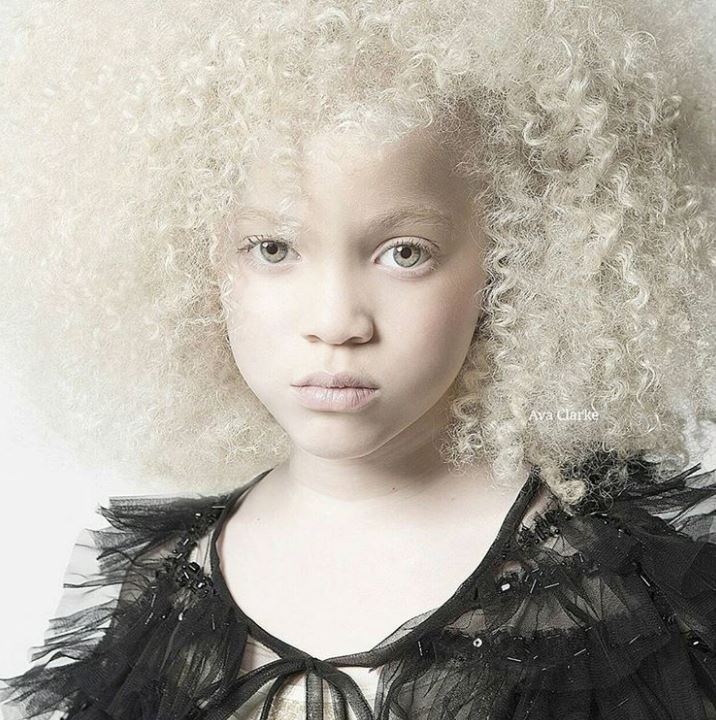 Ava Clarke — an African American girl with albinism