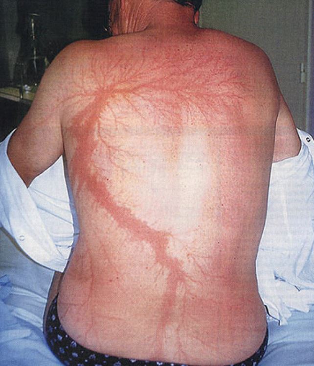 The peculiar marks that appear on the human body after a lightning strike are known as Lichtenberg figures. These are traces of burns that fade more and more with age but do not completely disappear. They are the result of the expansion of the capillaries located in the zone of contact of the lightning with the body.