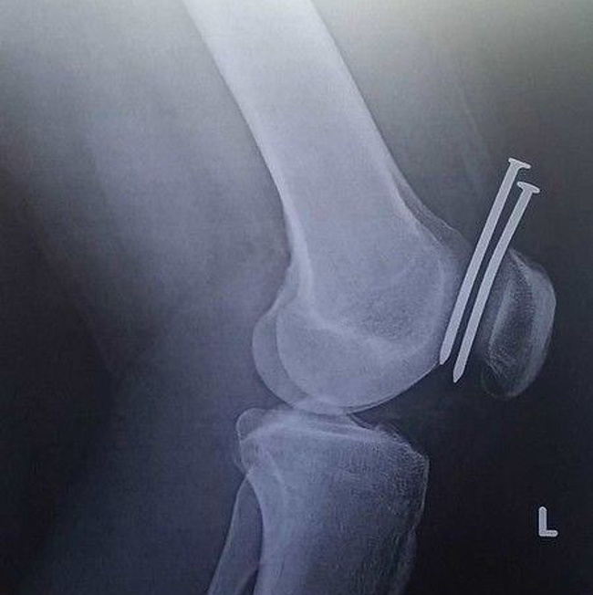 The nails passed between the kneecap and the femur without touching them.