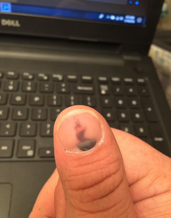 “My smashed thumb nail looks like a steaming bowl of soup.”
