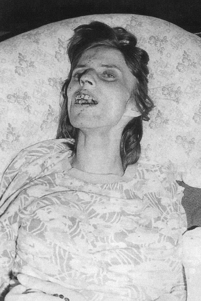 22 Year old Anneliese Michel, who was diagnosed with epileptic psychosis (temporal lobe epilepsy) and had a long and painfully unsuccessful history of psychiatric treatment, shown here during her Catholic Exorcism in Germany in 1975. It also proved unsuccessful, as most experts say she was not possessed just really sick, and sadly she died the following year. The audio of her Exorcism is on youtube if you are up for some noises you didn't know a human could make.