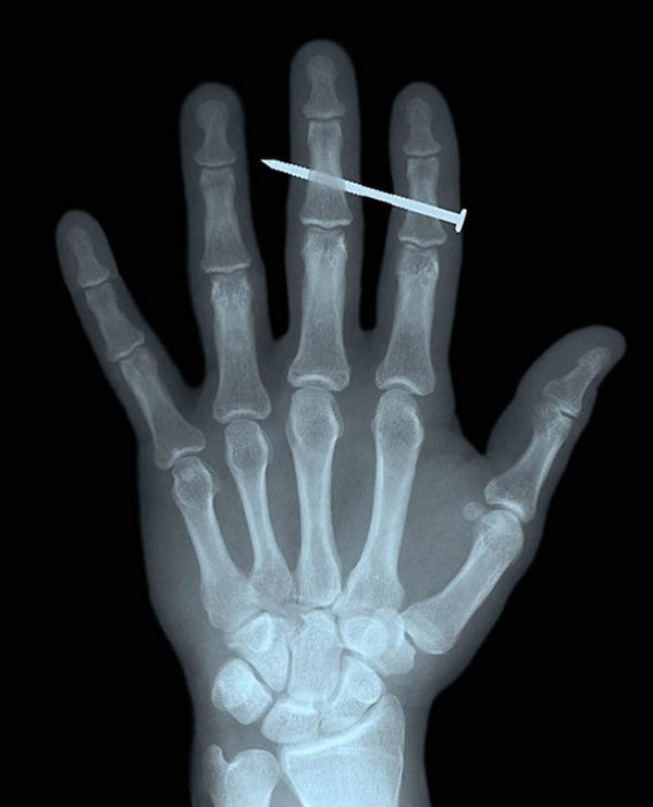 A screw in the finger.