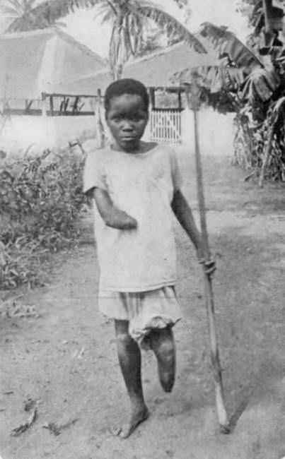 A child shows his missing limbs to missionaries in the Belgian Congo in 1905. The limbs were cut off by state militia after the family missed its quota of goods production. This was a common punishment in King Leopolds privately owned Belgian Congo at the time.