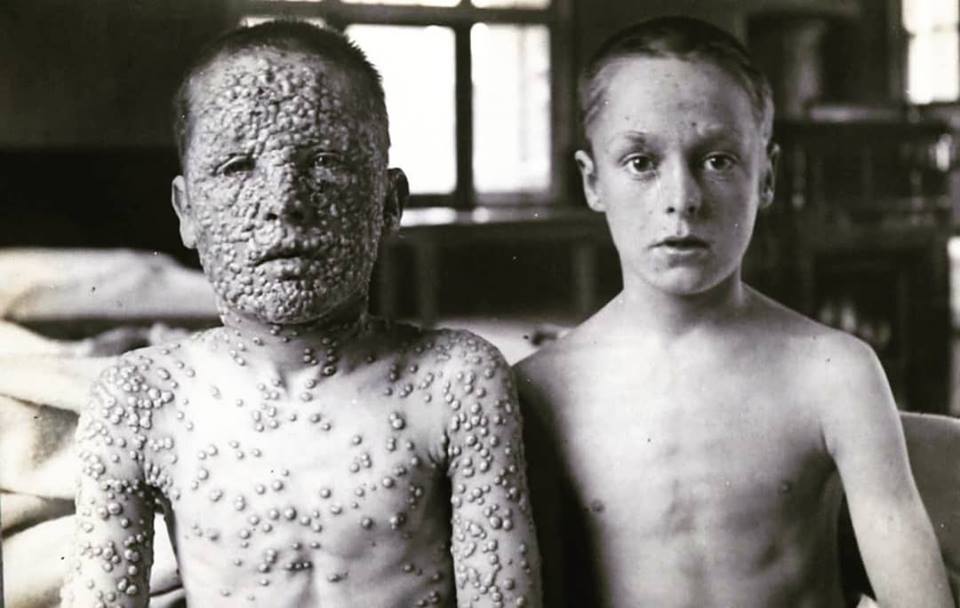 These two boys had been exposed to the same smallpox source. One had been vaccinated, the other hadn’t.