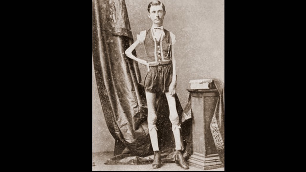 Isaac W. Sprague, The Human Skeleton.

Born in Massachusetts in 1841, was by all accounts a normal boy—at least until he got to the age of 12, when he began rapidly losing weight. Before long, his muscle mass had essentially dropped to nil, with his doctors being unable to explain exactly why (his condition was listed by at least one as “extreme progressive muscular atrophy”). At the age of 24, incapable of working any other jobs, he joined the sideshow.

At the age of 44, Sprague was officially measured by a doctor and found to be five feet six inches tall while weighing a mere 43 pounds. He died two years later of asphyxiation, probably as a result of his condition. As a result of Sprague’s popularity, “living skeleton” acts became common at many sideshows.