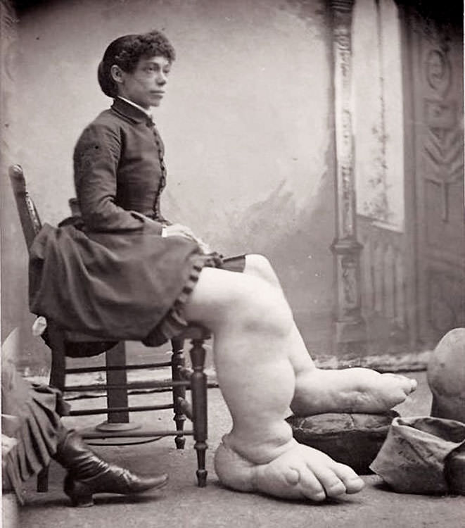 Fanny Mills, the Bigfoot Lady.

Born in 1860 with a condition known as Milroy’s Disease, which causes extreme swelling of the lower extremities. During her time in the circus, a reward of five thousand dollars was offered to any man willing to marry Fanny.

Fanny was already happily married, however, and her $150 a week salary afforded her a comfortable lifestyle until her death at an untimely age of 32.