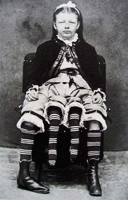 Myrtle Corbin, the Four-Legged Woman.

Myrtle Corbin was born in 1868 with a parasitic twin dangling from her midsection. She could move the legs of her twin, but they were malformed with only three toes. She earned $450 a week, an astronomical salary in the day. She had five children and passed away at age 60.