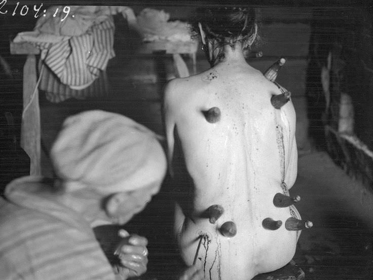 A woman doing a therapy known as Horn Cupping in Finland in 1930.