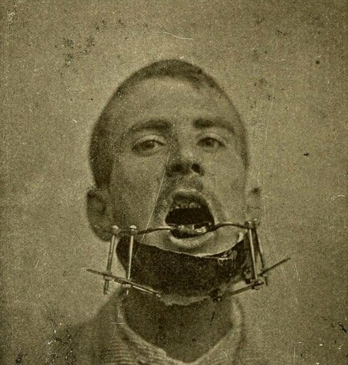 A device to treat a broken jaw in France in 1890.