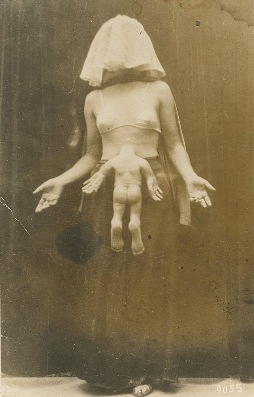 A freak show performer in France in 1911. This performer went on for years touring the world advertising she had absorbed the head of her twin and the twins body protruded out while inside the womb. It took nearly 6 years before it was exposed as a hoax.