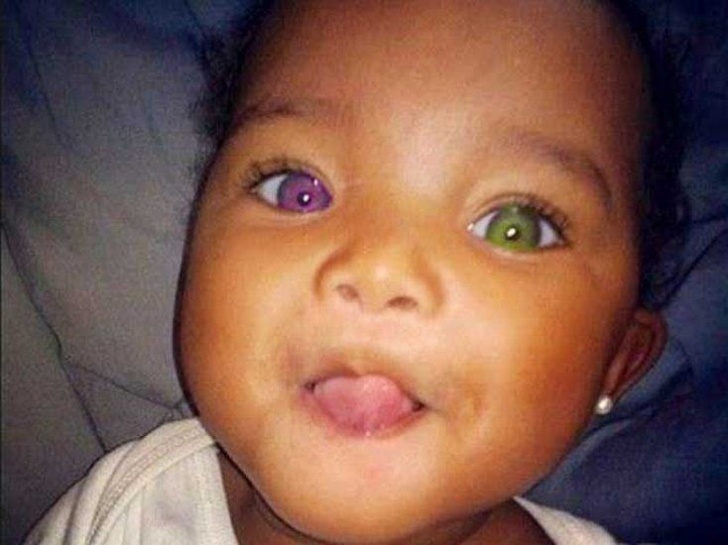 This African child has 2 different color eyes!