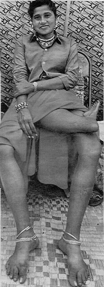 Shivshankari Yamanappa Mootageri, who was born with 3 legs, 2 of which grew disproportionately to her body, and the third, which was the fused legs of a second fetus her body absorbed in the womb, posing for a picture in India in 1978.