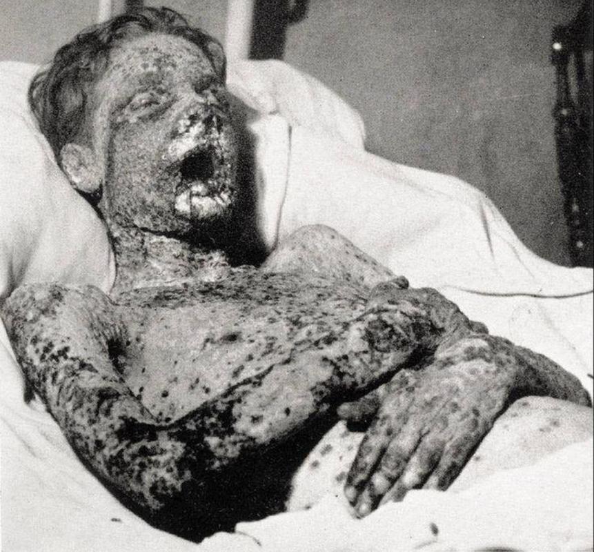 Smallpox, before the 1960s vaccine