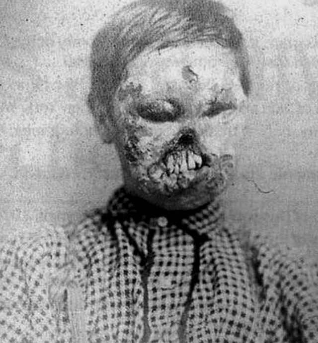 The result of congenital syphilis, before penicillin was discovered.