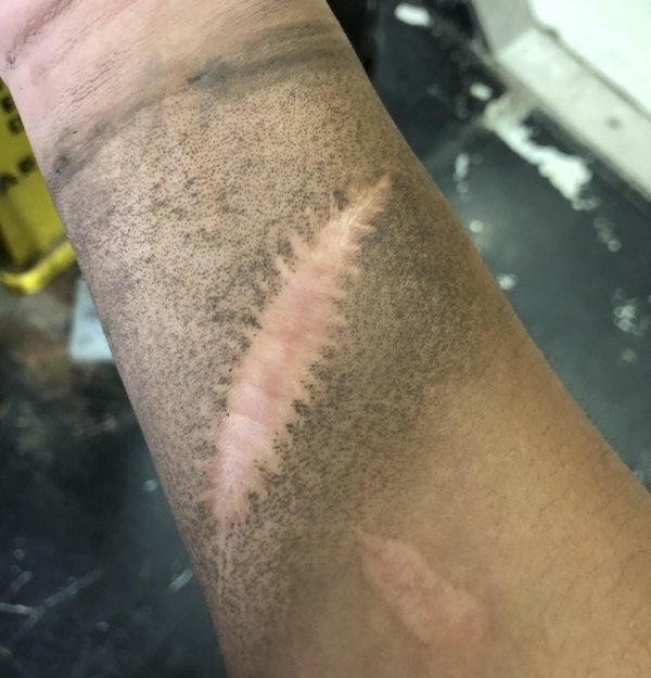 “My scar doesn’t get dirty when I’m at work.”