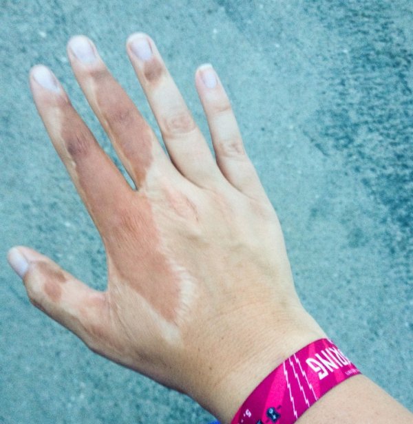 “The scar on my hand from a skin transplant from my upper arm gets more tan.”