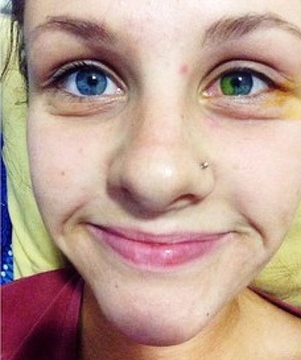 “A friend of mine got burned in her eye and the iris changed its color.”