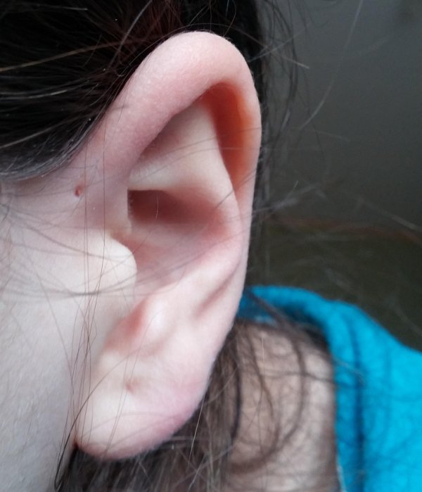 “No, it’s not a piercing. I inherited this preauricular sinus from my father.”