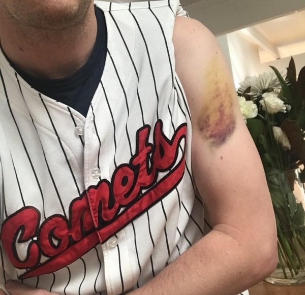 “My baseball bruise could be our team logo.”