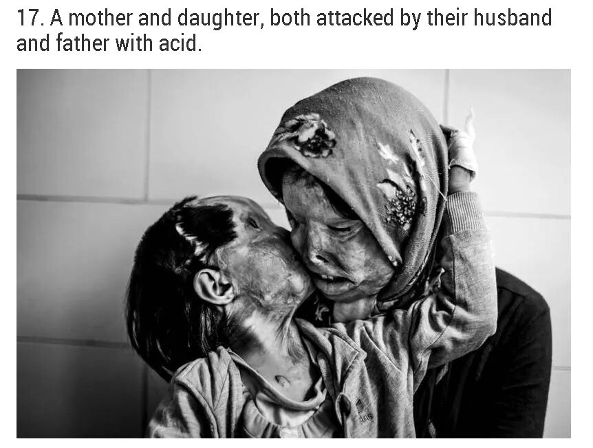 3 year old acid attack - 17. A mother and daughter, both attacked by their husband and father with acid.