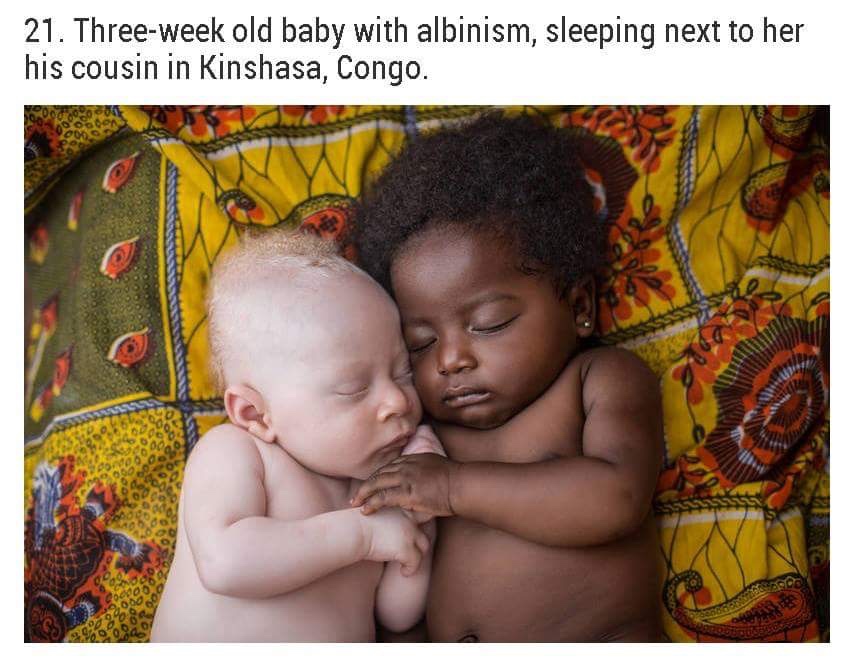 humanity should be our race love should - 21. Threeweek old baby with albinism, sleeping next to her his cousin in Kinshasa, Congo.